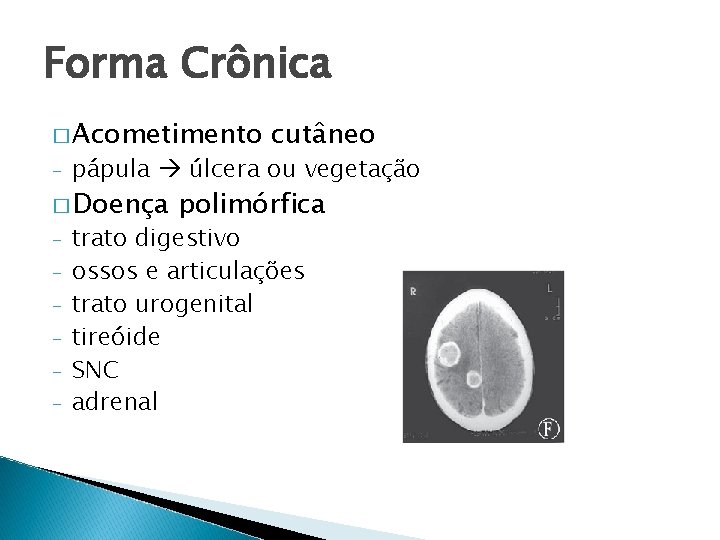 Forma Crônica � Acometimento cutâneo - pápula úlcera ou vegetação - trato digestivo ossos