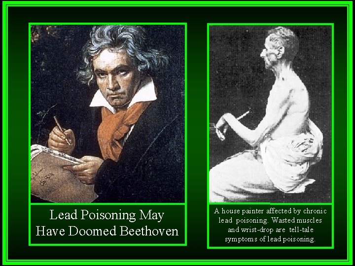 Lead Poisoning May Have Doomed Beethoven A house painter affected by chronic lead poisoning.