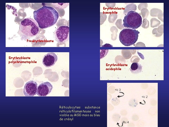 Erythroblaste basophile Proérythroblaste Erythroblaste polychromatophile Erythroblaste acidophile Réticulocytes: substance réticulofilamenteuse non visible au MGG