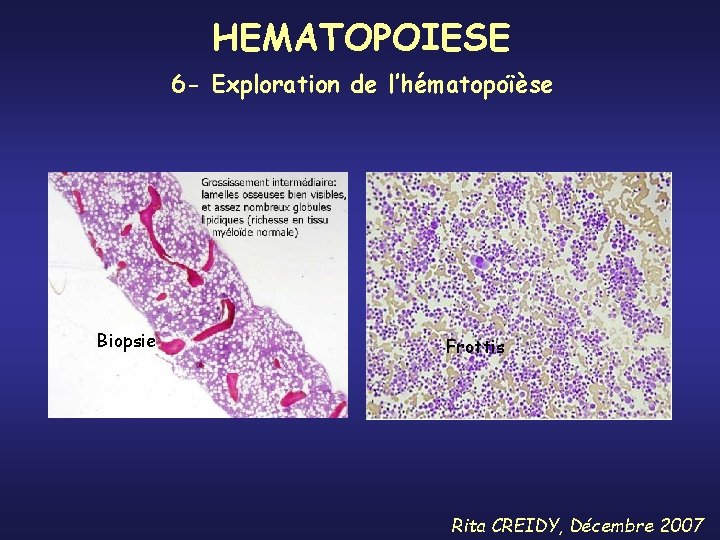 HEMATOPOIESE 6 - Exploration de l’hématopoïèse Biopsie Frottis Rita CREIDY, Décembre 2007 