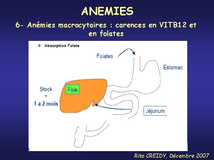 ANEMIES 6 - Anémies macrocytaires : carences en VITB 12 et en folates Rita