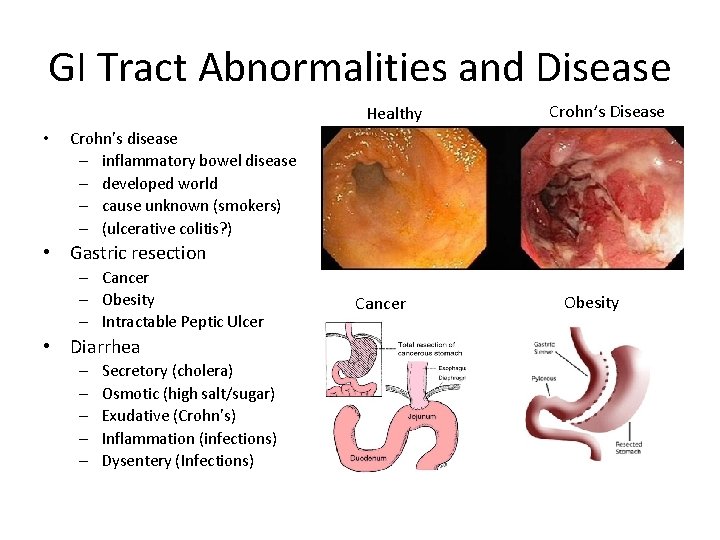 GI Tract Abnormalities and Disease Healthy • Crohn’s Disease Crohn’s disease – inflammatory bowel