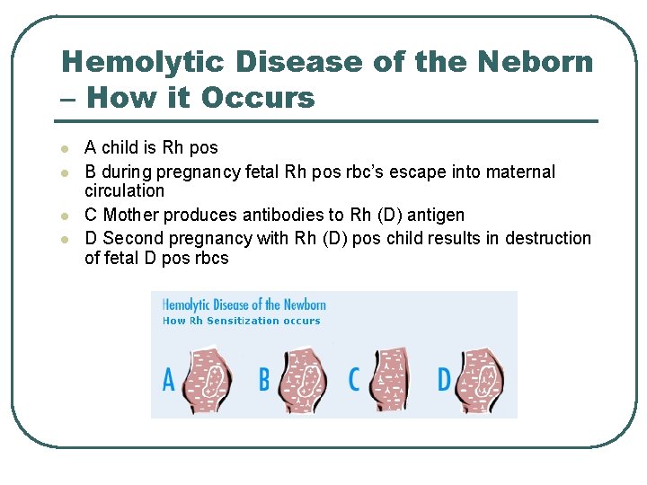 Hemolytic Disease of the Neborn – How it Occurs l l A child is