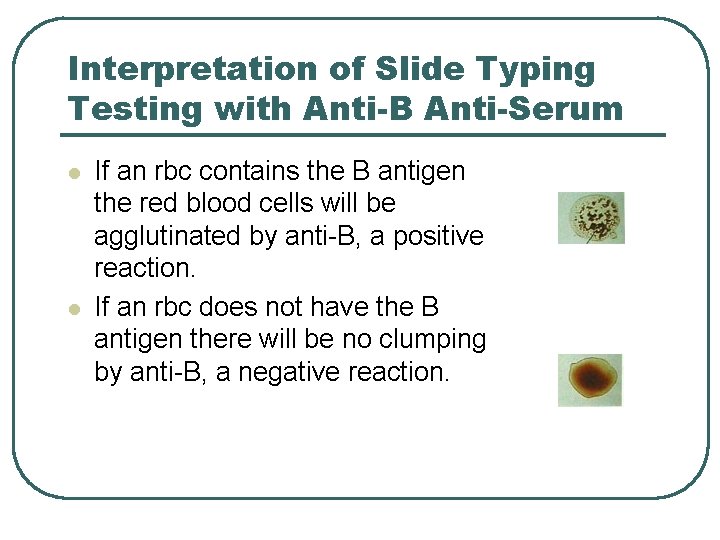 Interpretation of Slide Typing Testing with Anti-B Anti-Serum l l If an rbc contains