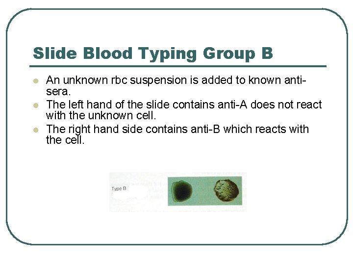 Slide Blood Typing Group B l l l An unknown rbc suspension is added