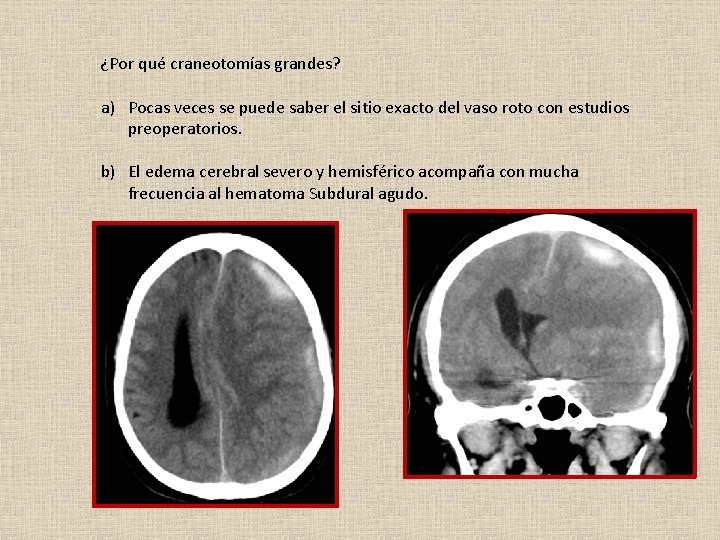 ¿Por qué craneotomías grandes? a) Pocas veces se puede saber el sitio exacto del