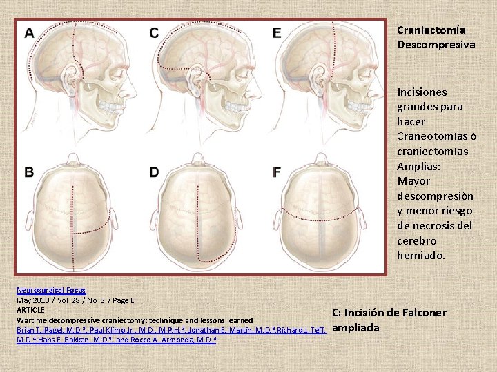 Craniectomía Descompresiva Incisiones grandes para hacer Craneotomías ó craniectomías Amplias: Mayor descompresiòn y menor