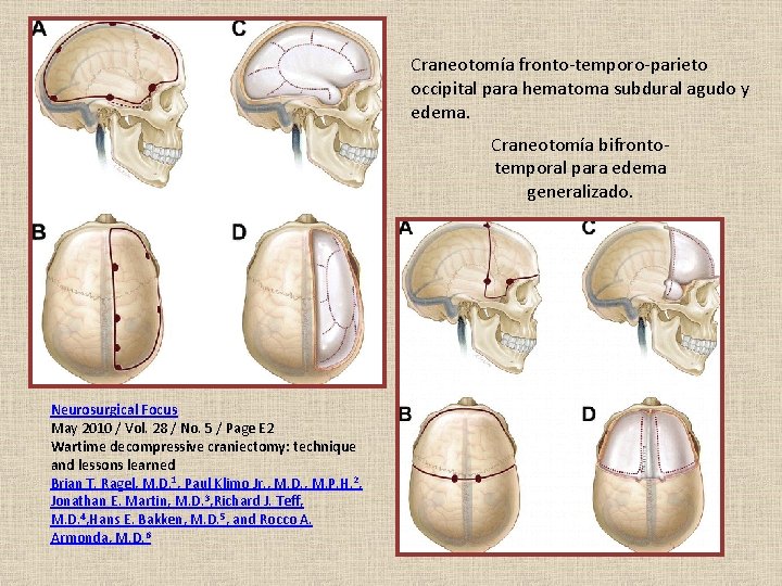 Craneotomía fronto-temporo-parieto occipital para hematoma subdural agudo y edema. Craneotomía bifrontotemporal para edema generalizado.
