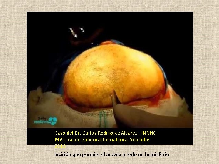 Caso del Dr. Carlos Rodríguez Alvarez , INNNC MVS: Acute Subdural hematoma. You. Tube
