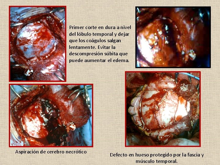 Primer corte en dura a nivel del lóbulo temporal y dejar que los coágulos