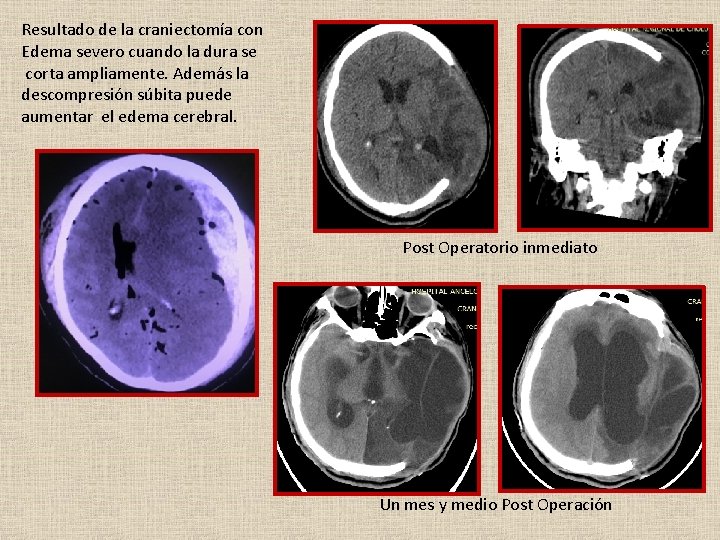 Resultado de la craniectomía con Edema severo cuando la dura se corta ampliamente. Además