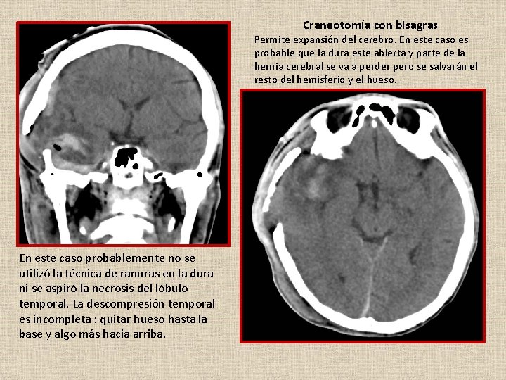 Craneotomía con bisagras Permite expansión del cerebro. En este caso es probable que la