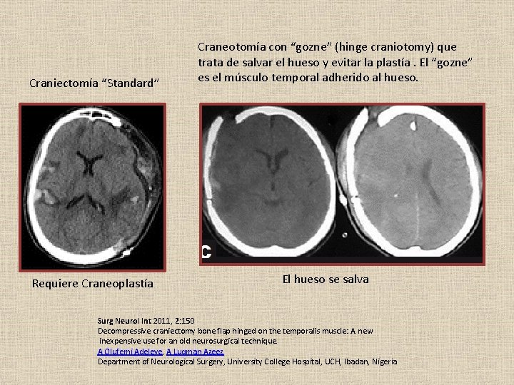 Craniectomía “Standard” Requiere Craneoplastía Craneotomía con “gozne” (hinge craniotomy) que trata de salvar el