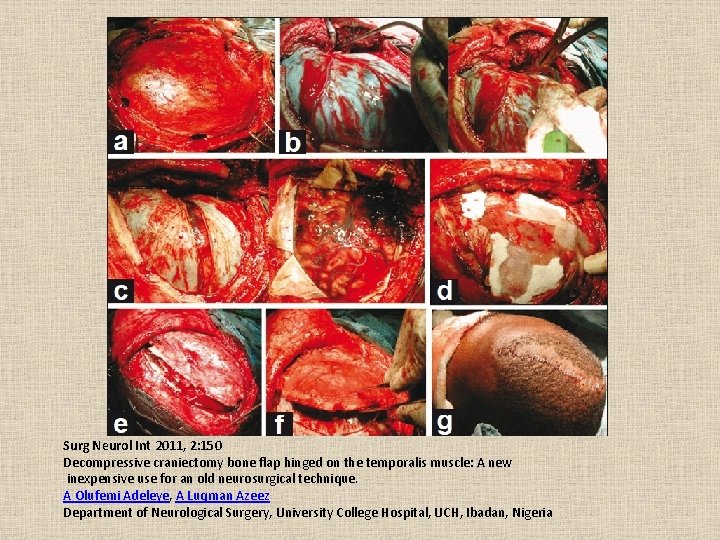 Surg Neurol Int 2011, 2: 150 Decompressive craniectomy bone flap hinged on the temporalis