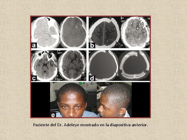 Paciente del Dr. Adeleye mostrado en la diapositiva anterior. 