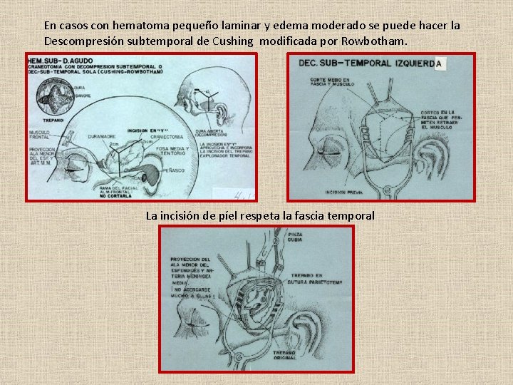 En casos con hematoma pequeño laminar y edema moderado se puede hacer la Descompresión