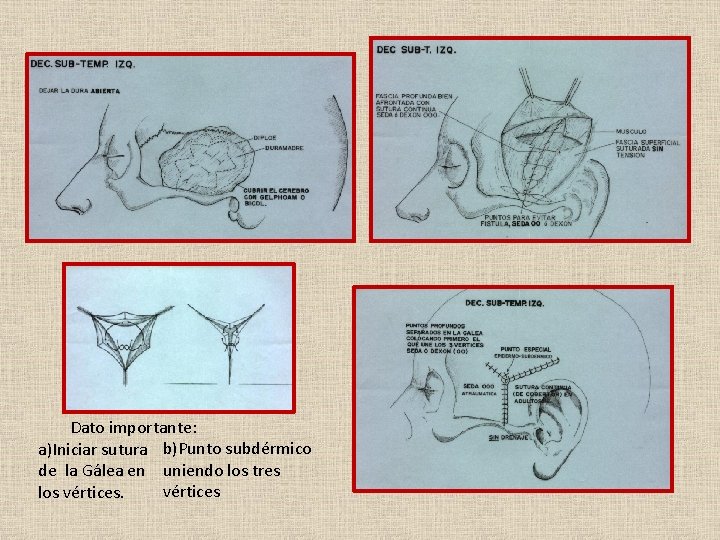 Dato importante: a)Iniciar sutura b)Punto subdérmico de la Gálea en uniendo los tres vértices