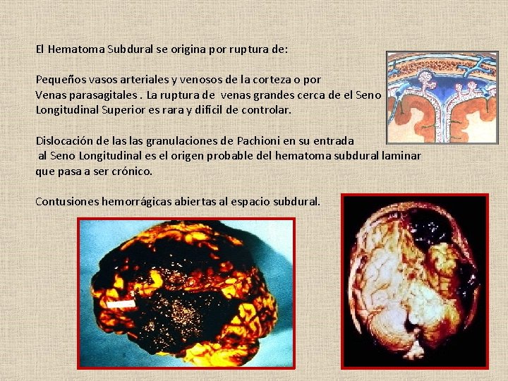 El Hematoma Subdural se origina por ruptura de: Pequeños vasos arteriales y venosos de