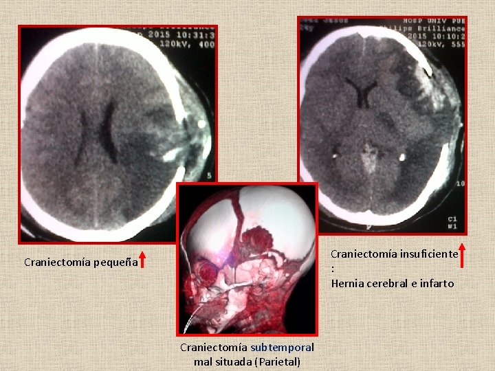 Craniectomía insuficiente : Hernia cerebral e infarto Craniectomía pequeña Craniectomía subtemporal mal situada (Parietal)