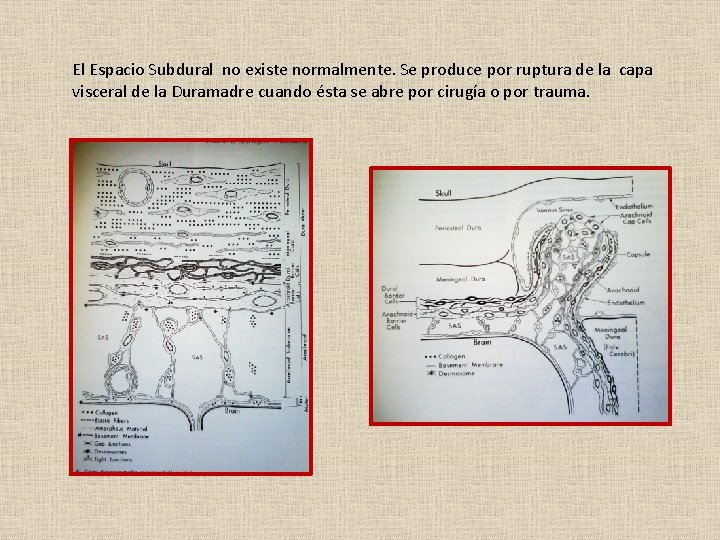 El Espacio Subdural no existe normalmente. Se produce por ruptura de la capa visceral