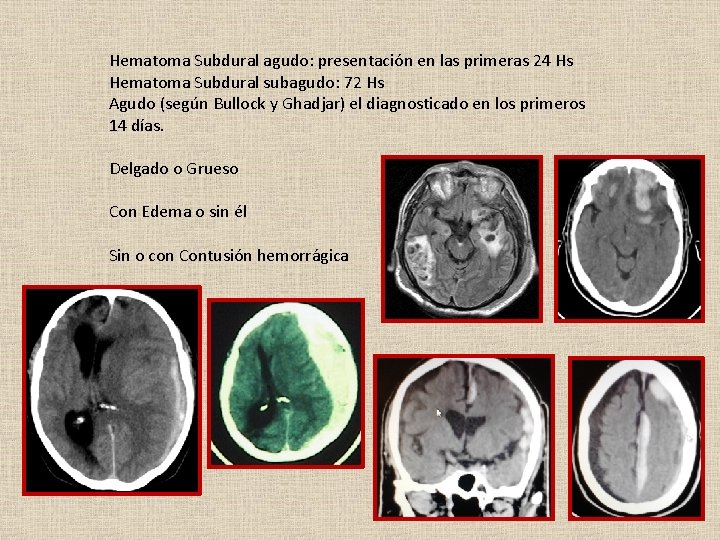 Hematoma Subdural agudo: presentación en las primeras 24 Hs Hematoma Subdural subagudo: 72 Hs