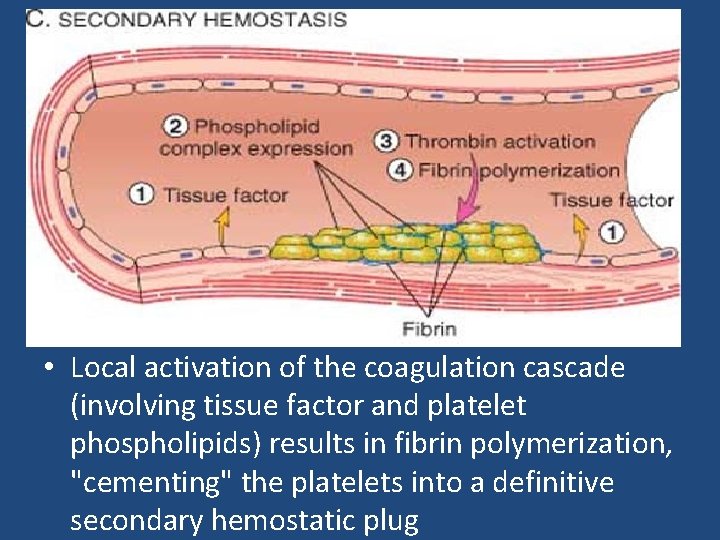  • Local activation of the coagulation cascade (involving tissue factor and platelet phospholipids)