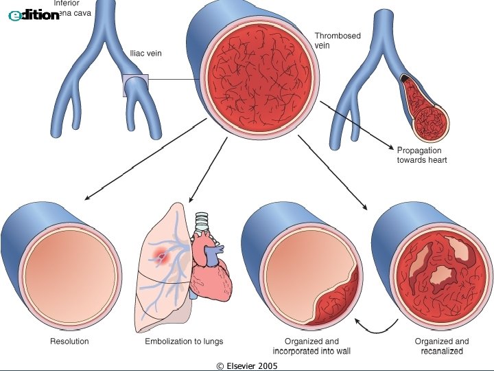 Downloaded from: Robbins & Cotran Pathologic Basis of Disease (on 1 April 2005 08: