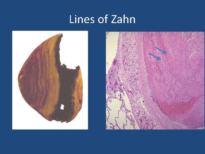 Lines of Zahn 