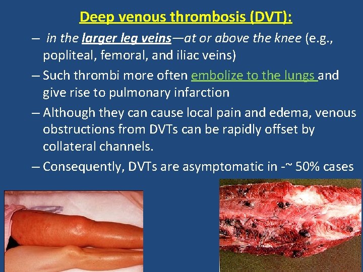 Deep venous thrombosis (DVT): – in the larger leg veins—at or above the knee
