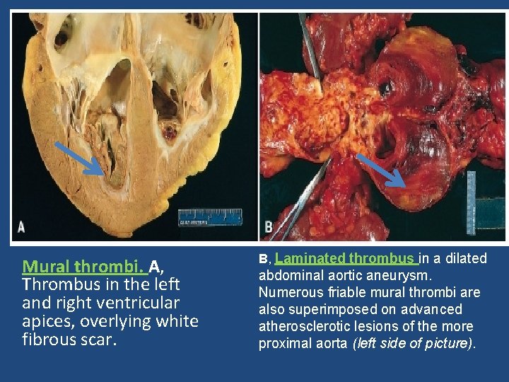 Mural thrombi. A, Thrombus in the left and right ventricular apices, overlying white fibrous