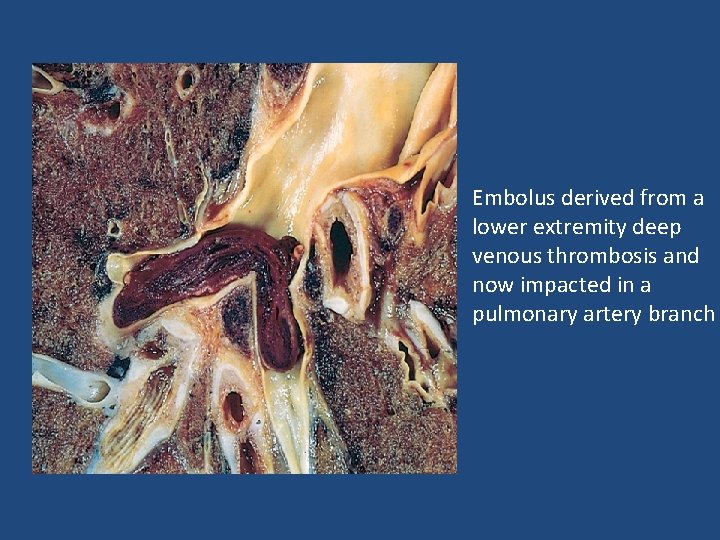 Embolus derived from a lower extremity deep venous thrombosis and now impacted in a