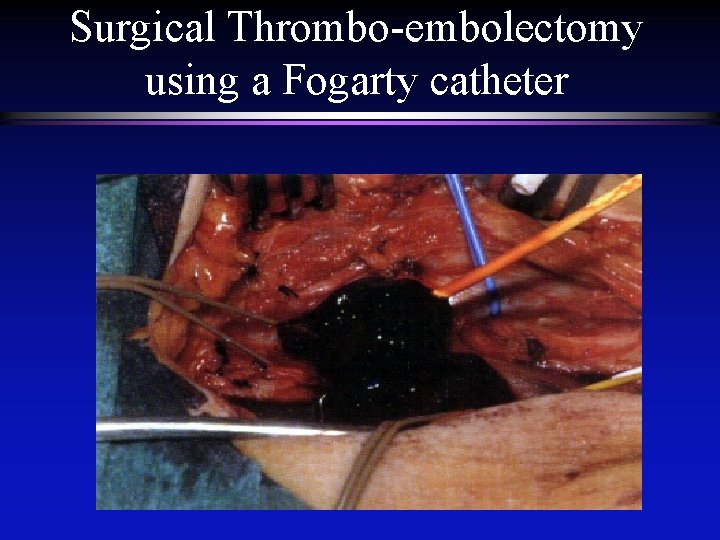 Surgical Thrombo-embolectomy using a Fogarty catheter 