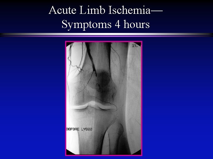 Acute Limb Ischemia— Symptoms 4 hours 