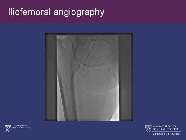 Iliofemoral angiography 