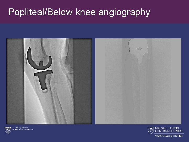 Popliteal/Below knee angiography 