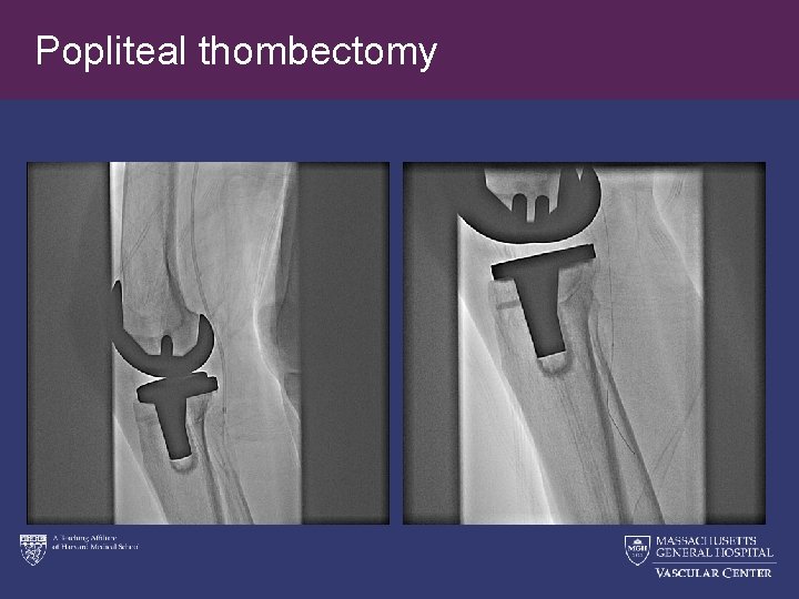 Popliteal thombectomy 