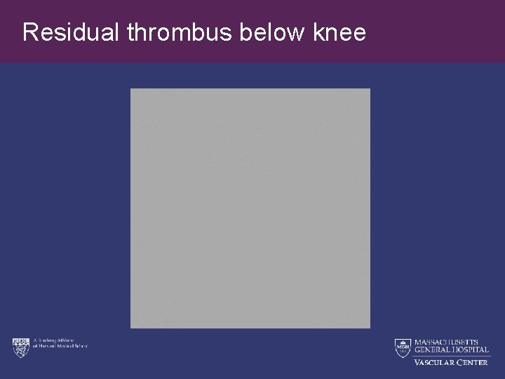 Residual thrombus below knee 