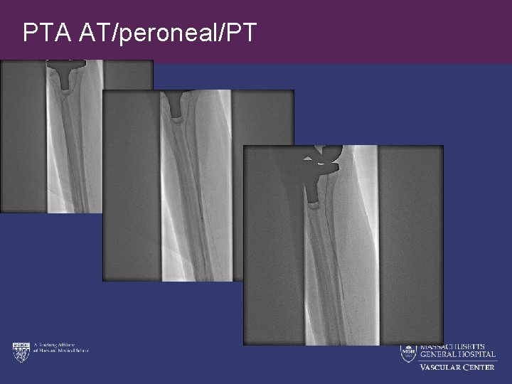 PTA AT/peroneal/PT 