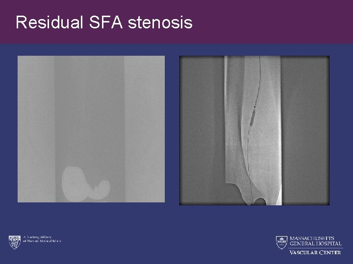 Residual SFA stenosis 