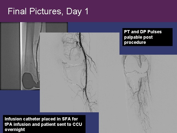 Final Pictures, Day 1 PT and DP Pulses palpable post procedure Infusion catheter placed