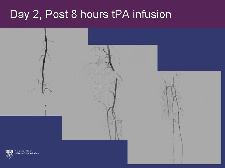 Day 2, Post 8 hours t. PA infusion 