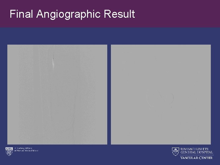 Final Angiographic Result 