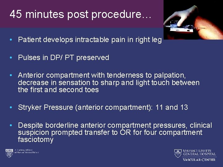 45 minutes post procedure… • Patient develops intractable pain in right leg • Pulses