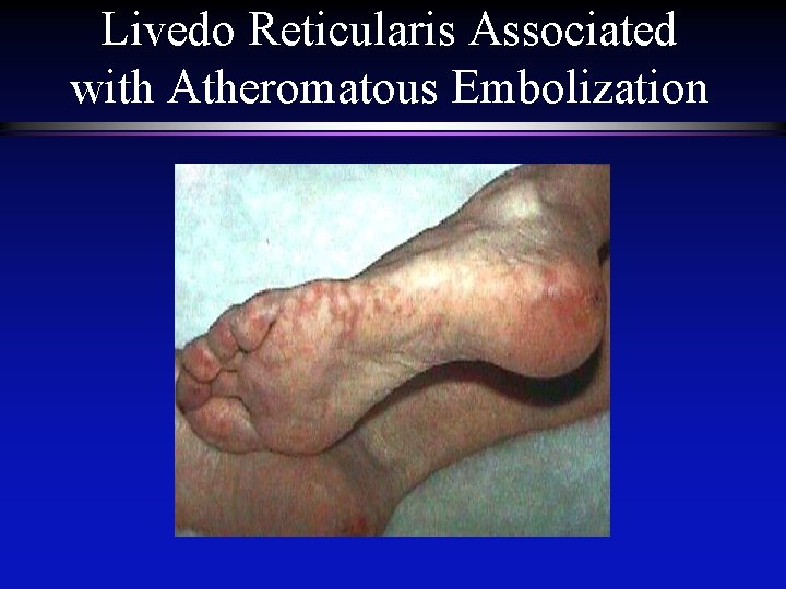 Livedo Reticularis Associated with Atheromatous Embolization 