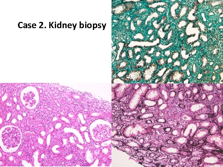 Case 2. Kidney biopsy 