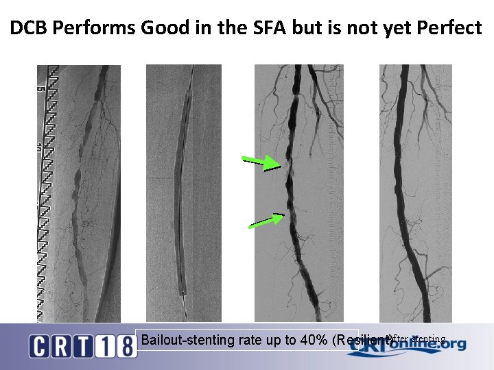 DCB Performs Good in the SFA but is not yet Perfect After stenting Bailout-stenting