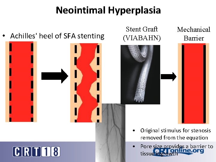 Neointimal Hyperplasia • Achilles' heel of SFA stenting Stent Graft (VIABAHN) Mechanical Barrier •