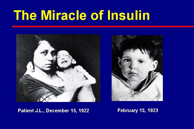 The Miracle of Insulin Patient J. L. , December 15, 1922 February 15, 1923
