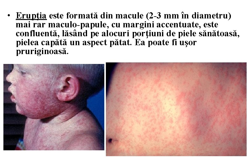  • Erupţia este formată din macule (2 -3 mm în diametru) mai rar