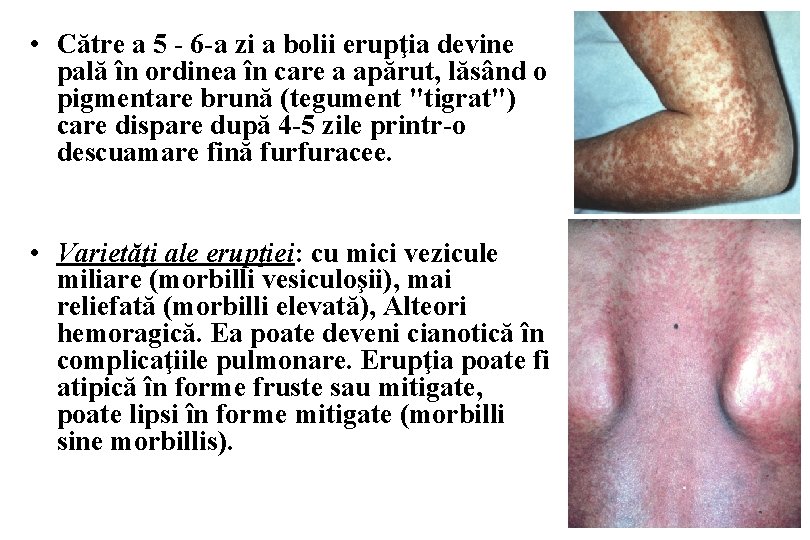  • Către a 5 - 6 -a zi a bolii erupţia devine pală